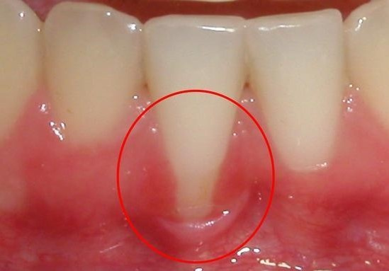 健存口腔牙龈萎缩具体是什么原因引起的